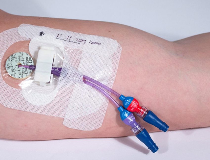 Catheter Stabilization Devices Market