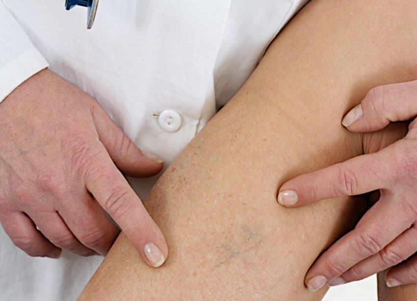 Varicose Vein Treatment Devices Market