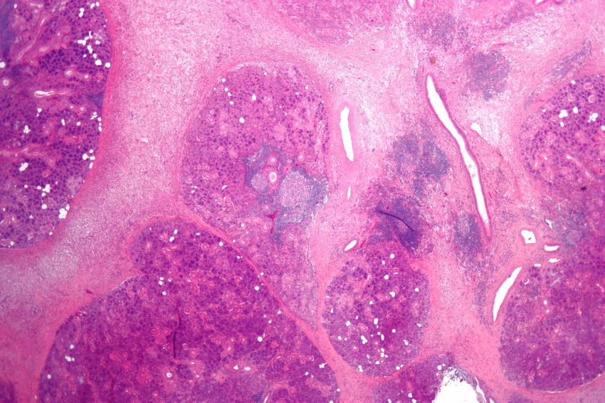 Bacterial Sialadenitis Market