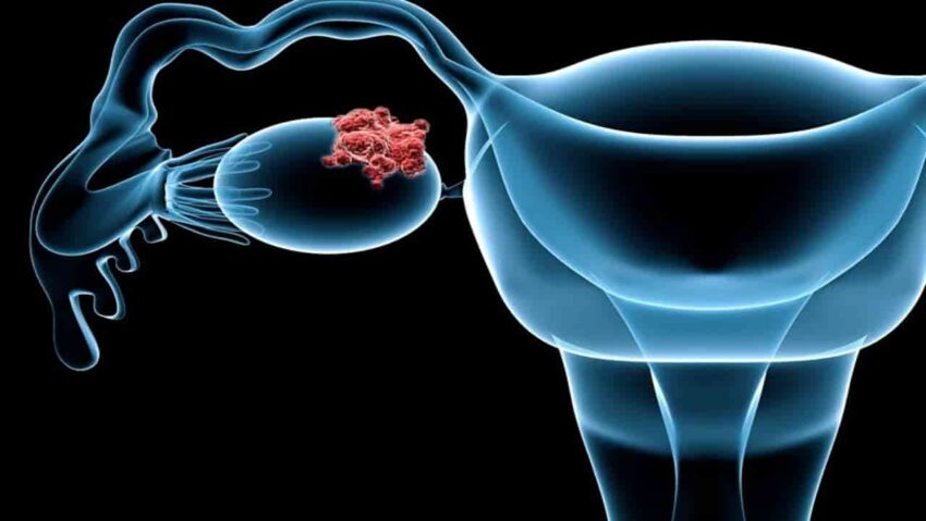 Ovarian Cancer