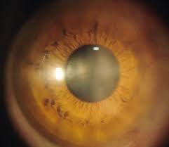 Amniotic Membrane Market