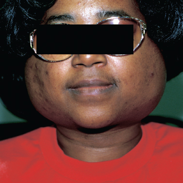 Bacterial Sialadenitis Market