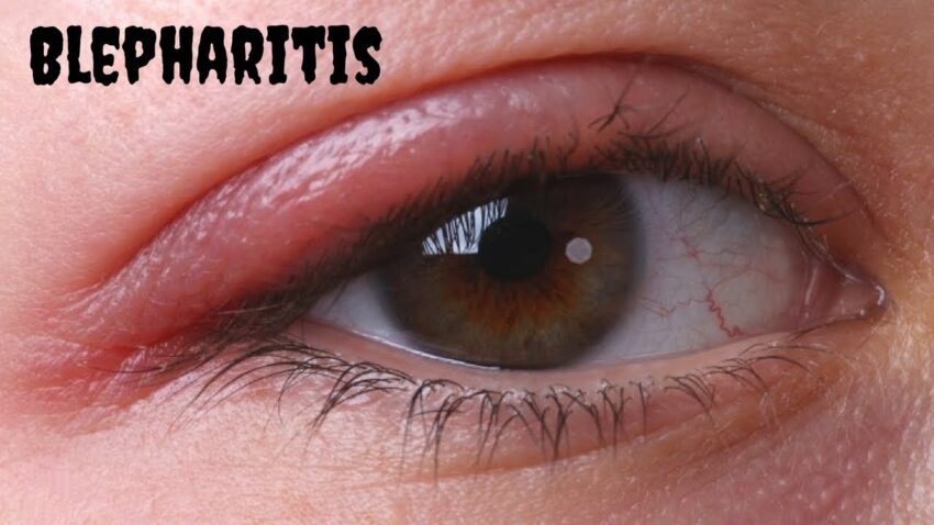 Blepharitis Treatment Market