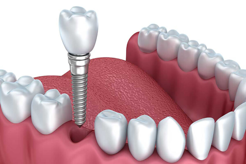 Dental Implants Market