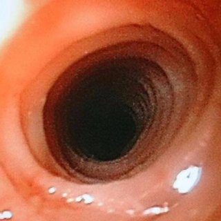 Eosinophilic Esophagitis Market