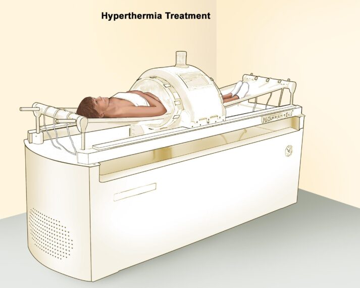 Hyperthermia Cancer Treatment Market