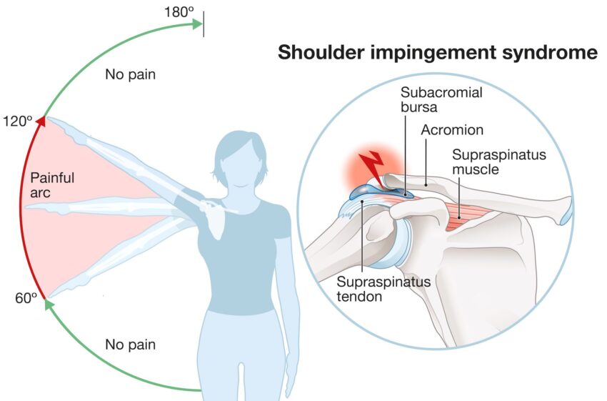 Impingement Syndrome Market
