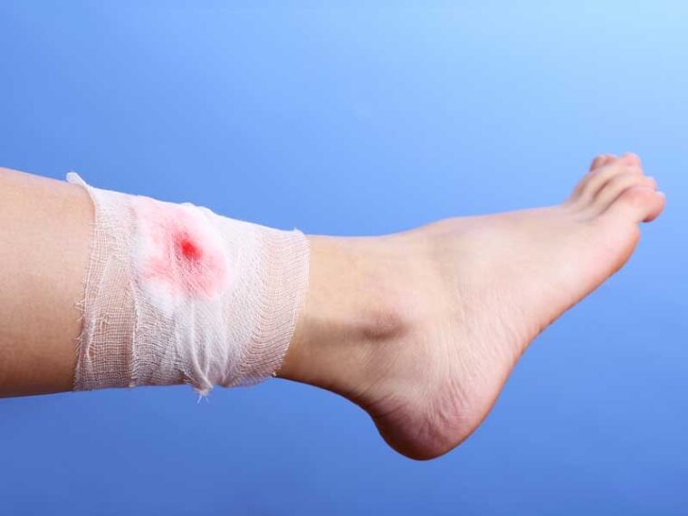 India Advanced Wound Care Management Market