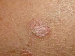Actinic Keratosis Market