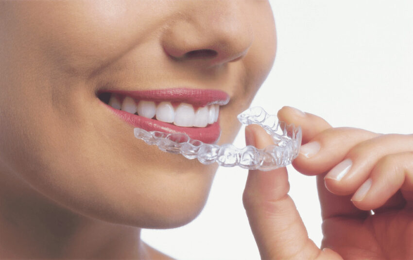 Clear Aligners Market