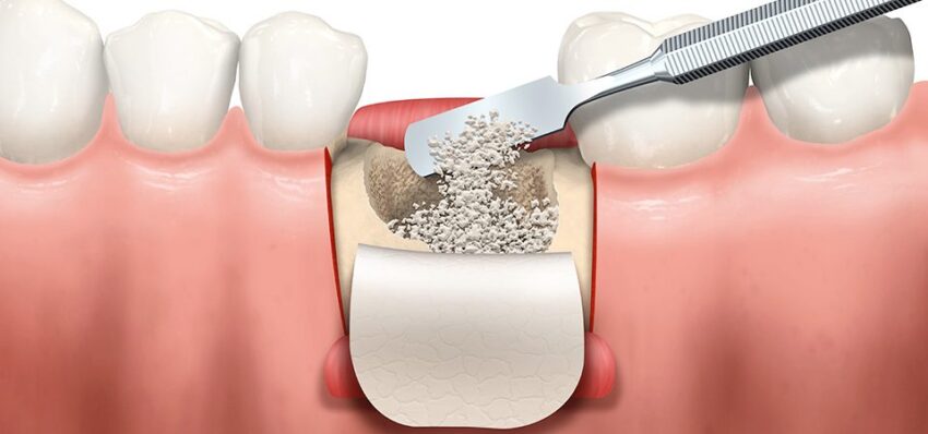 Dental Membrane And Bone Graft Substitute Market