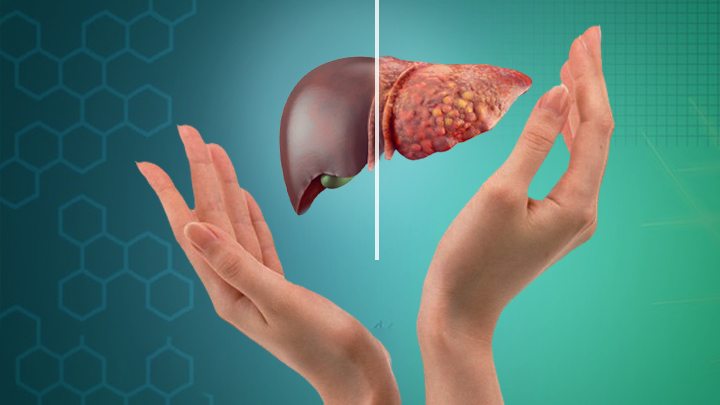 Fatty Liver Disease