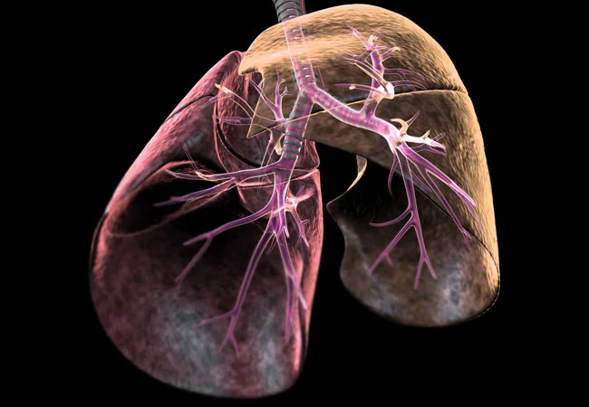 Interstitial Lung Disease Market