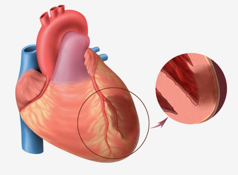 Myocardial Infarction Market