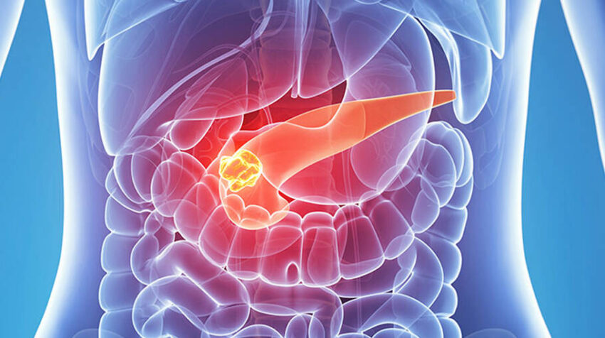 Neuroendocrine Tumor Treatment Market