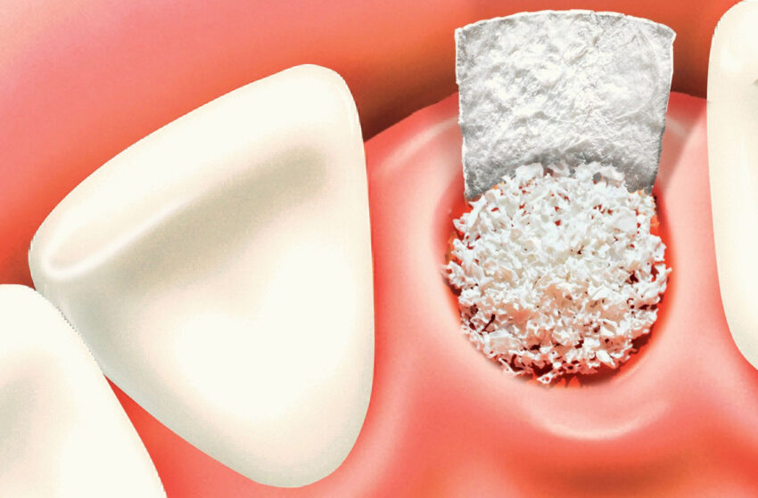 Dental Membrane And Bone Graft Substitute Market