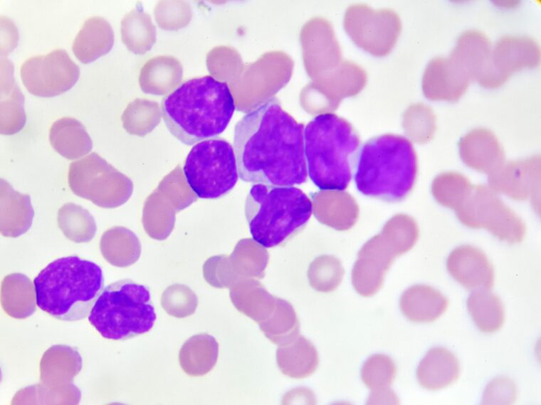 Myeloid Mutations Found to Cause High-Risk Adult Acute Lymphoblastic Leukemia