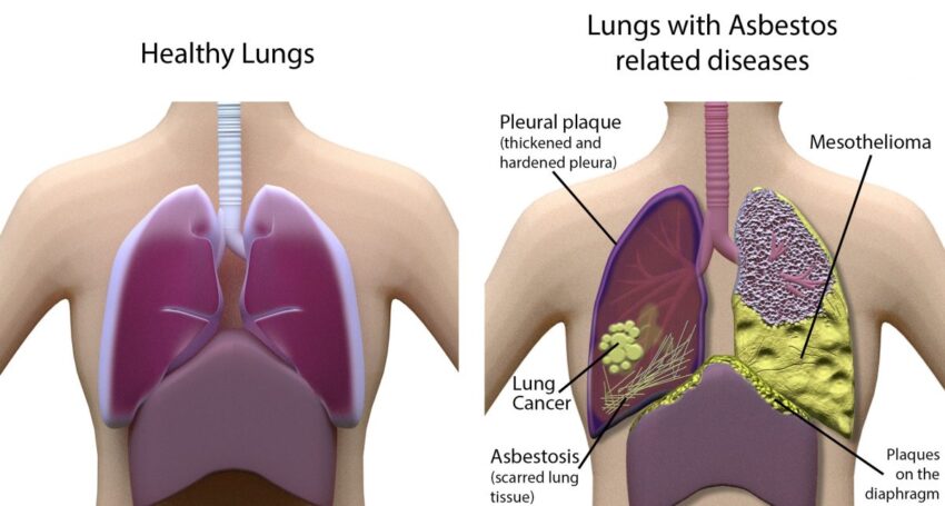 Pleural Diseases Market