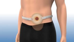 Colostomy Bags Market
