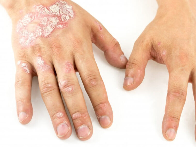 Eczema Therapeutics Market