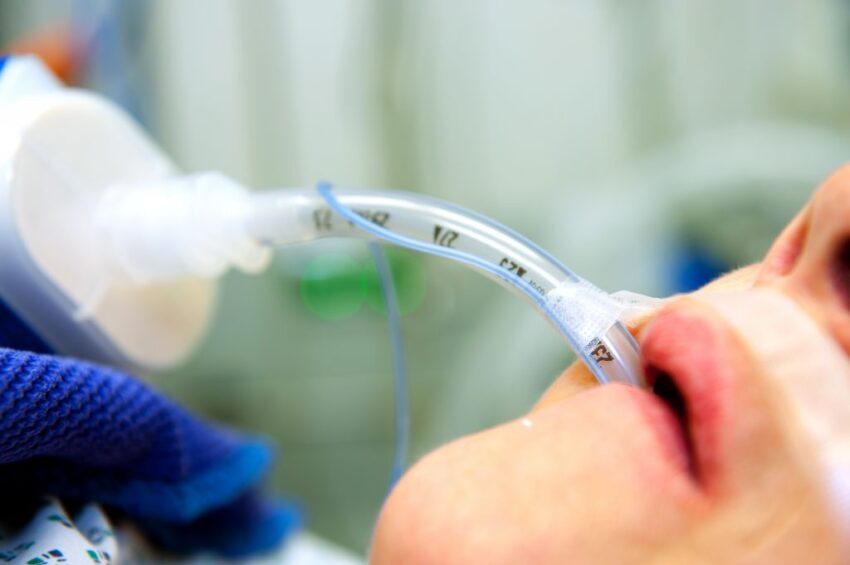 Endotracheal Tube