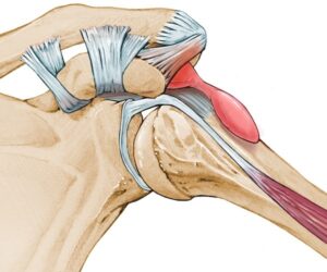 Impingement Syndrome
