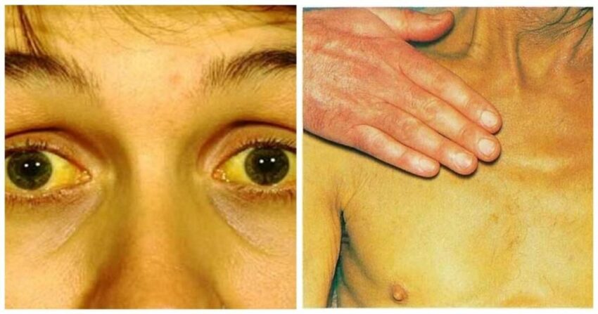 Jaundice Meter Market