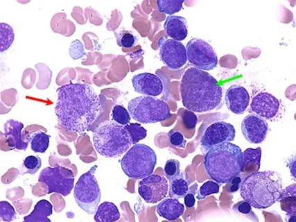 New Study Uses Proteogenomics to Tackle Drug Resistance in Acute Myeloid Leukemia