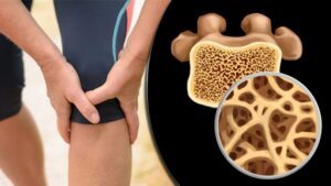 Osteoporosis Treatment
