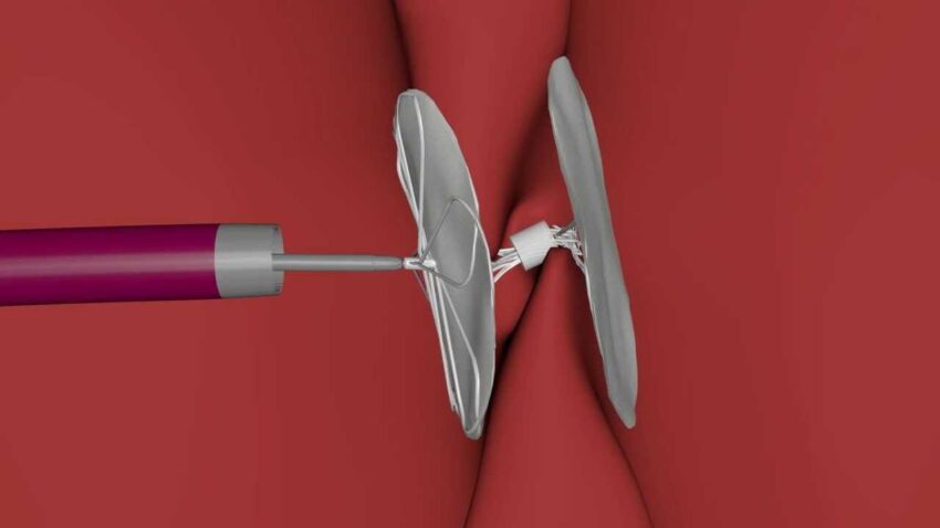 Patent Foramen Ovale (PFO) Closure Devices market