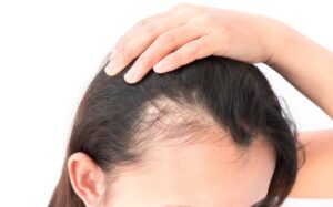 Alopecia Treatment Market
