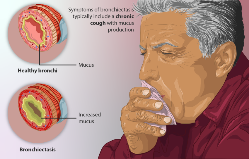 Bronchiectasis Drugs