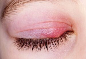 Blepharitis Treatment Market.jpg