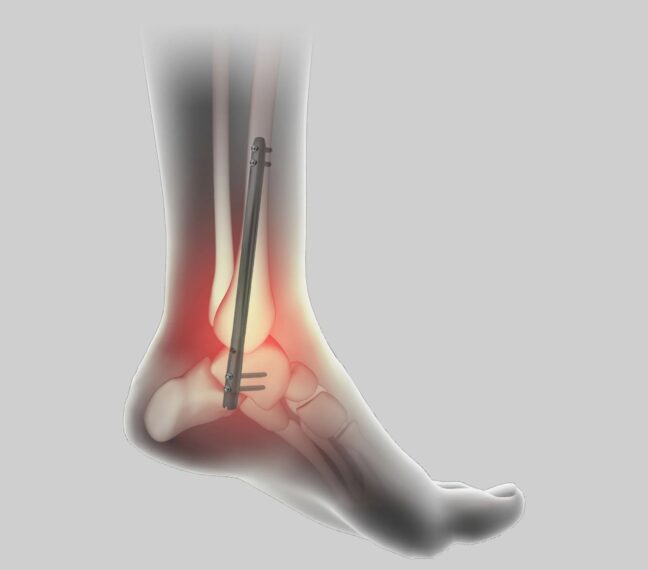 Global Ankle Fusion Nail Market