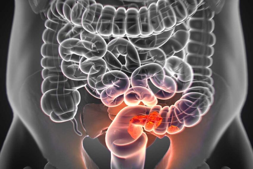 U.S. Colorectal Cancer Screening
