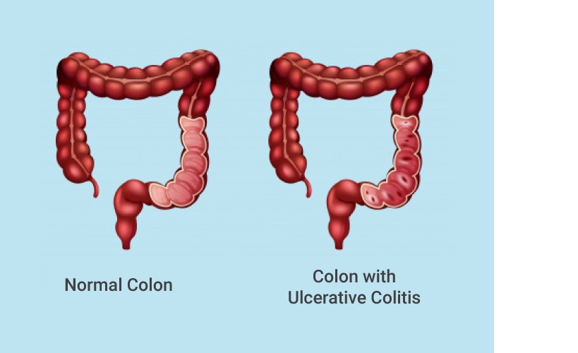 United Kingdom Ulcerative Colitis