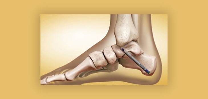 Global Ankle Fusion Nail