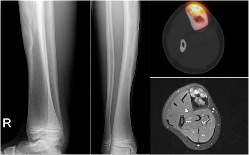 Bone Tumor Ablation Devices Market