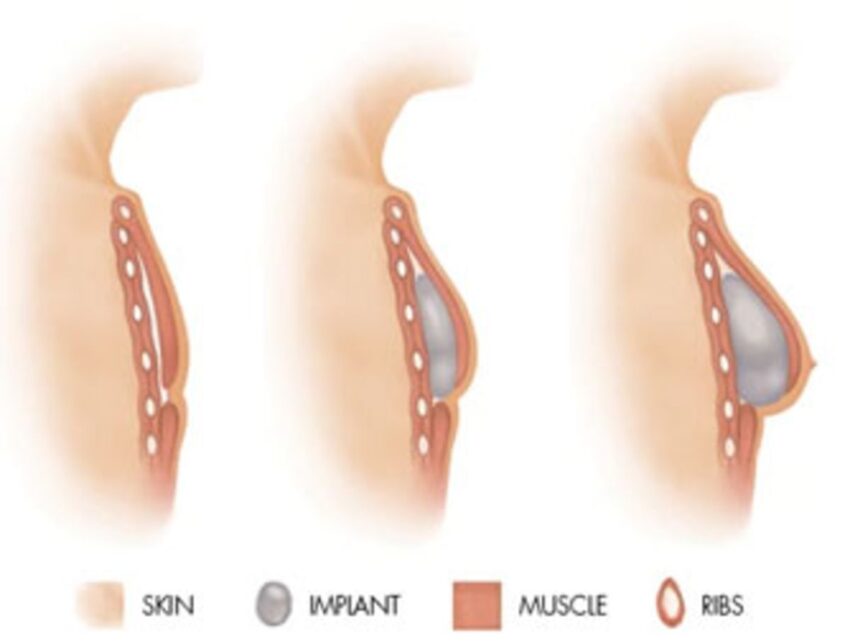 Breast Reconstruction