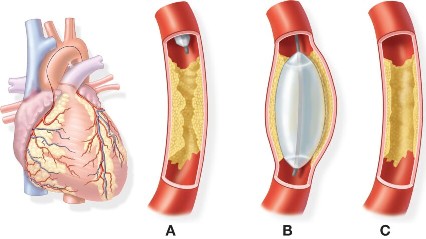 Coronary Artery Bypass Grafting Market