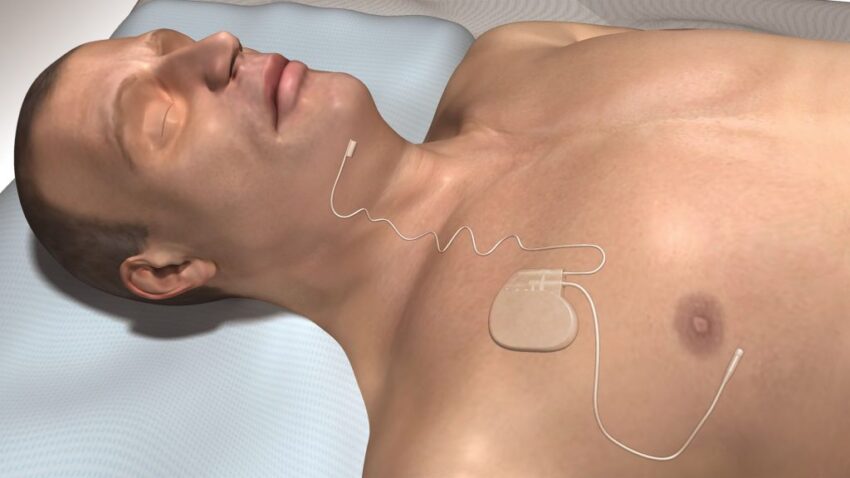 Sleep Apnea Implants