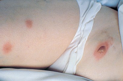 Blastomycosis Treatment Market