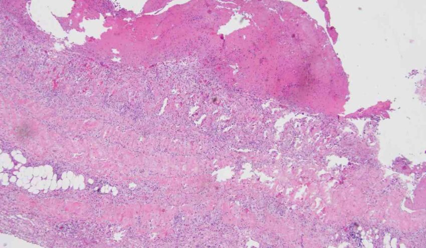 Bullous Pemphigoid Market