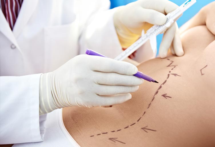 Liposuction Surgery Devices Market