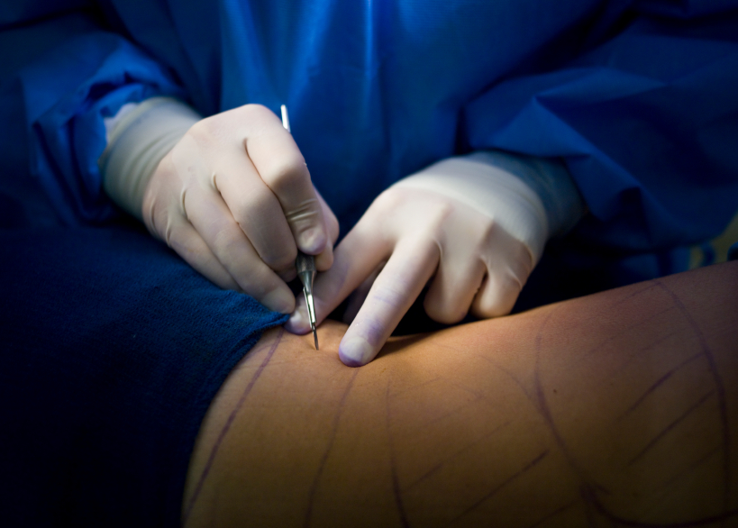 Liposuction Surgery Devices