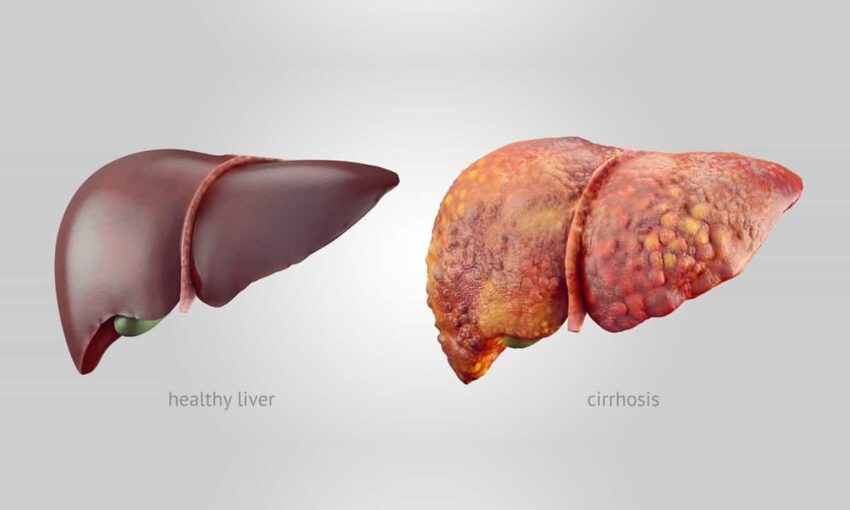 Liver Cirrhosis