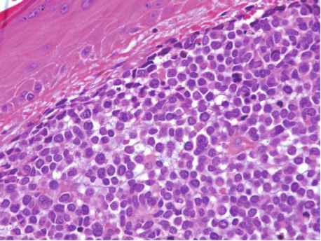 Merkel Cell Carcinoma Market
