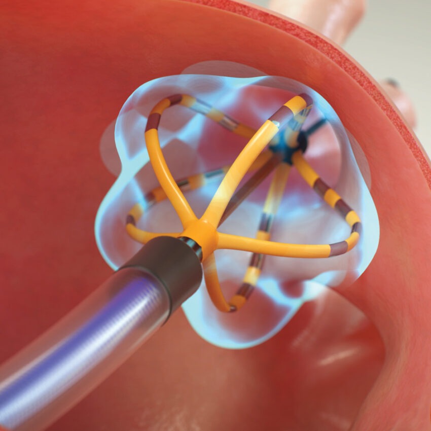 Pulsed Field Ablation Market
