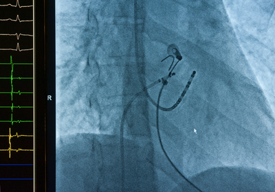 Implantable Cardiac Monitors Market Trend, Implantable Cardiac Monitors Market Size, Implantable Cardiac Monitors Market Information, Implantable Cardiac Monitors Market Analysis, Implantable Cardiac Monitors Market Demand