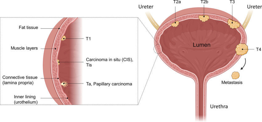 Non Muscle Invasive Bladder Cancer Market